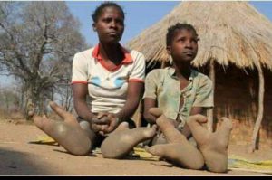 Meet the Vadoma tribe of Zimbabwe with only two toes and forbidden to marry AdvertAfrica News on afronewswire.com: Amplifying Africa's Voice | afronewswire.com | Breaking News & Stories